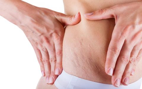 Best-Home-Remedies-To-Get-Rid-Of-Stretch-Marks-For-Men